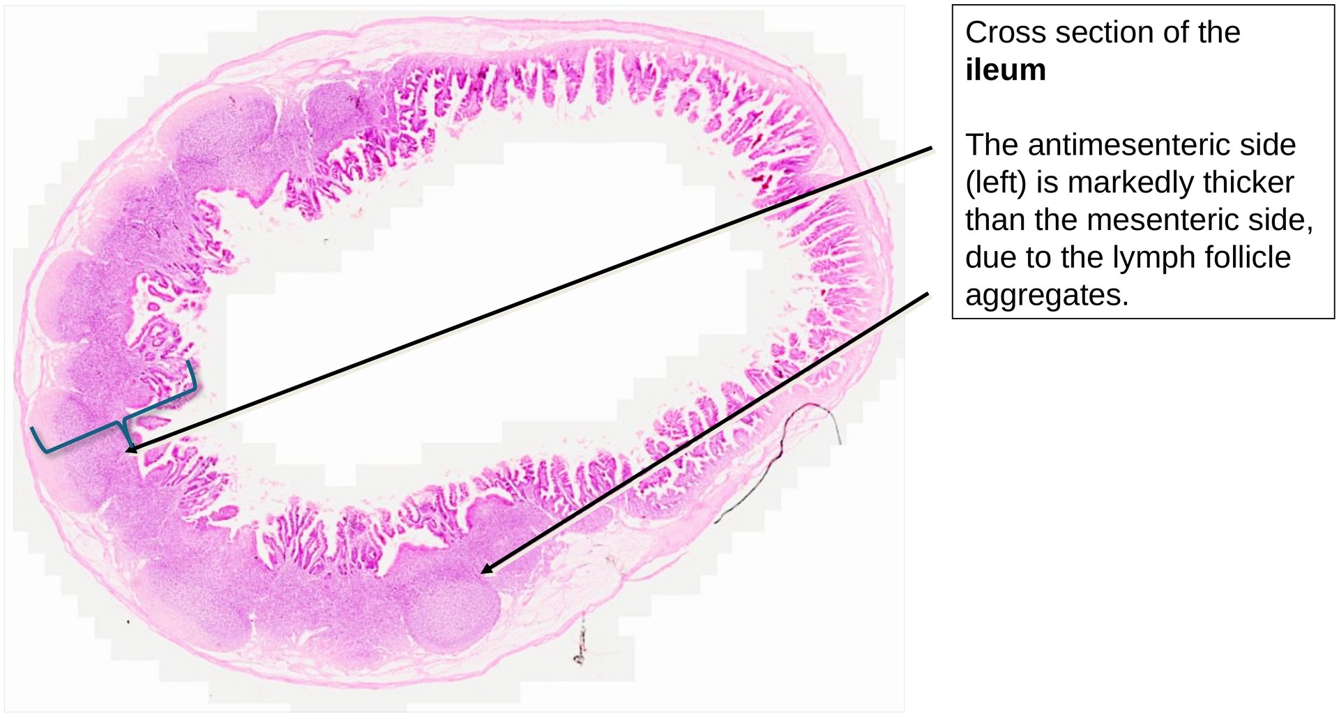 Ileum, Peyer’s patches