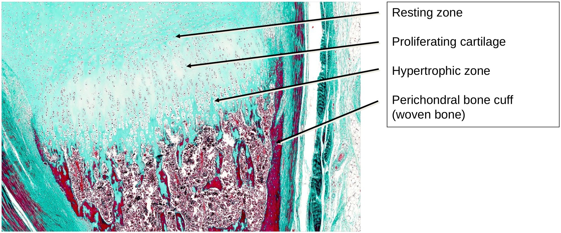 Ossification, perichondral (Finger)