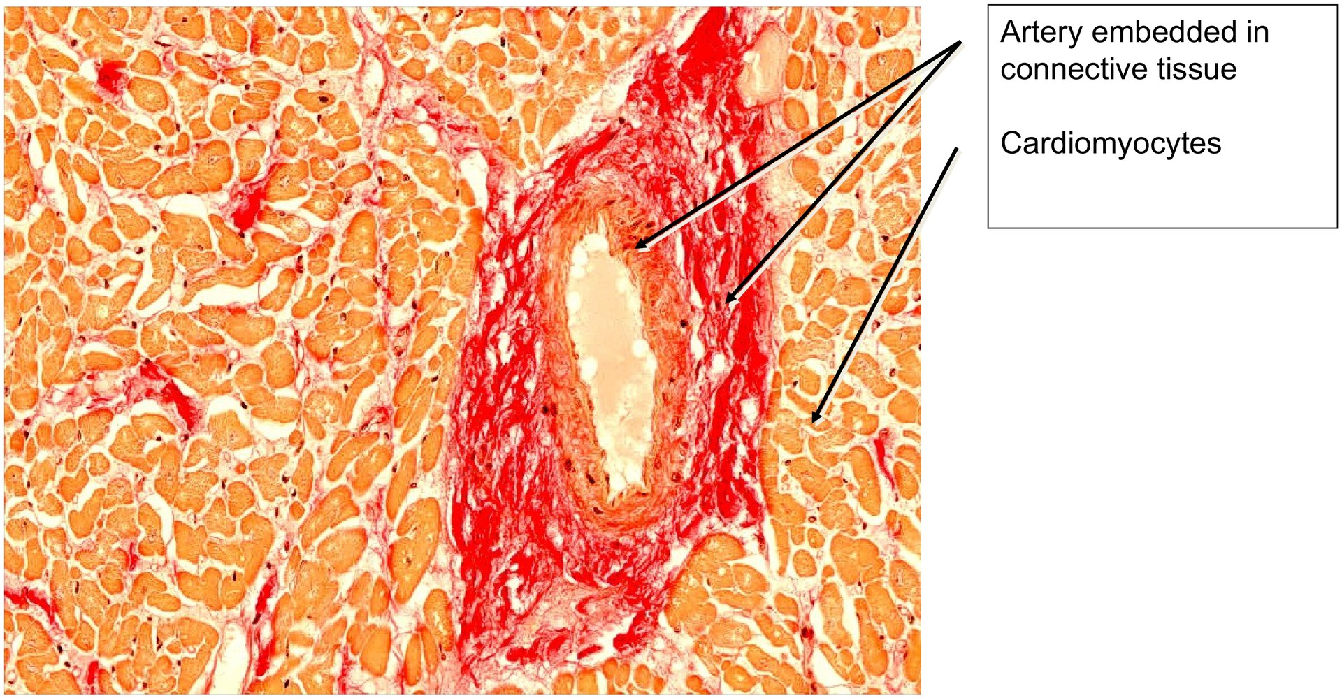 Papillary muscle