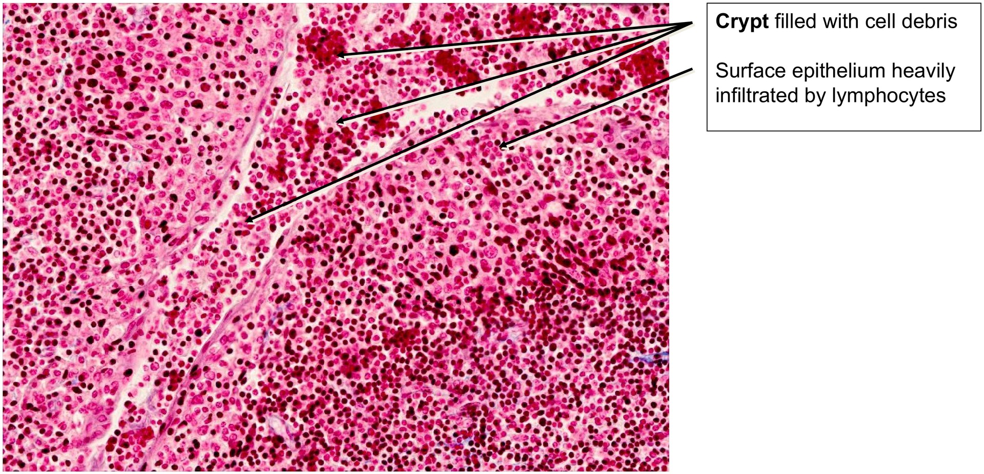 Lingual tonsil, base of tongue