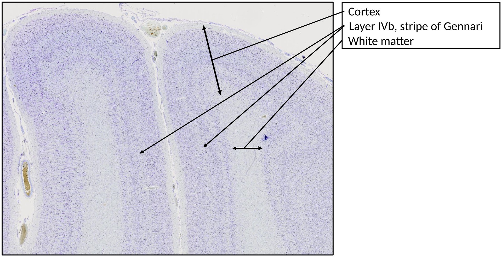 Cerebrum 3 (calcarine sulcus)