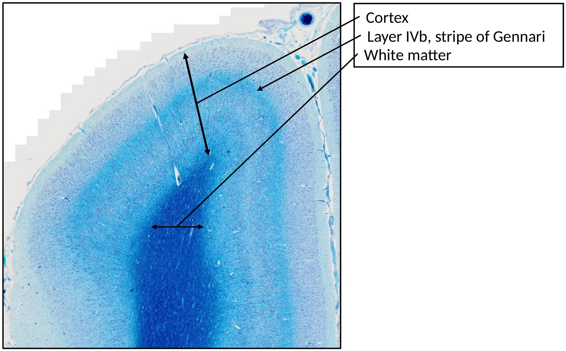 Cerebrum 3 (calcarine sulcus)
