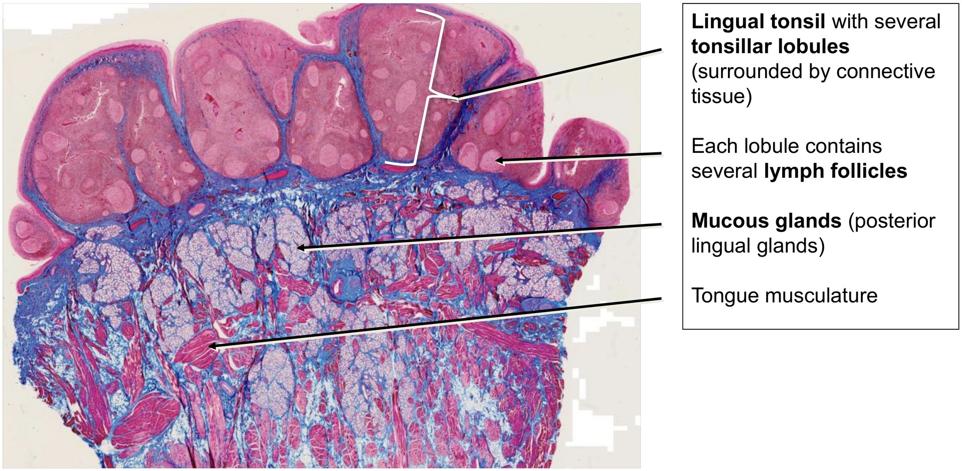 Lingual tonsil, base of tongue
