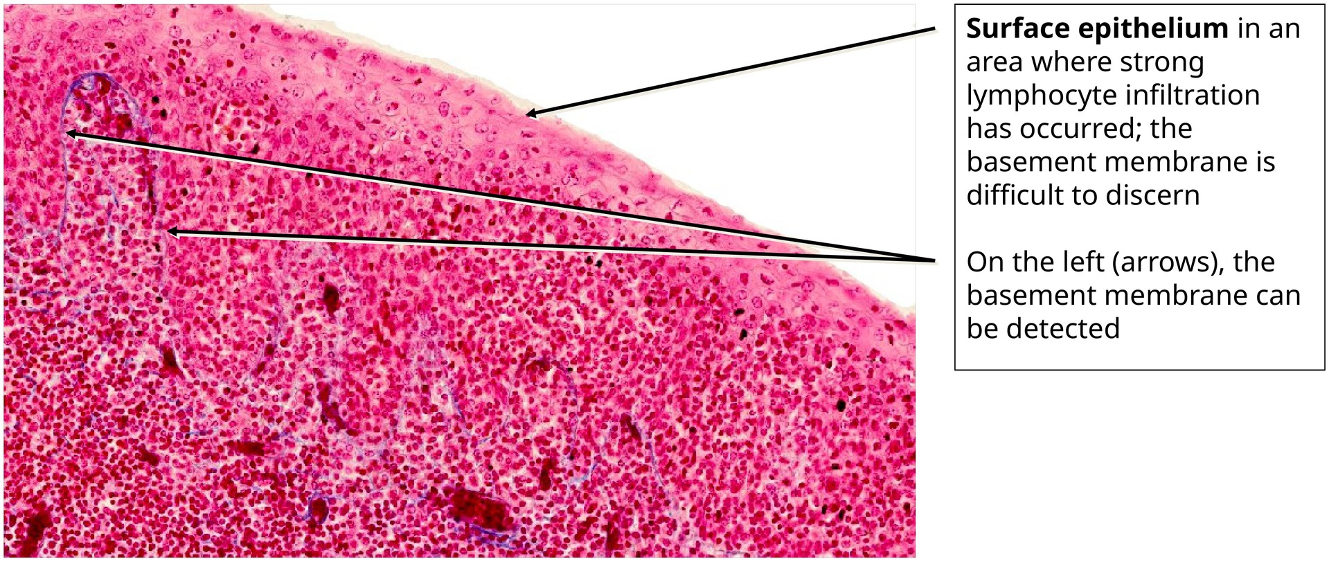 Lingual tonsil, base of tongue