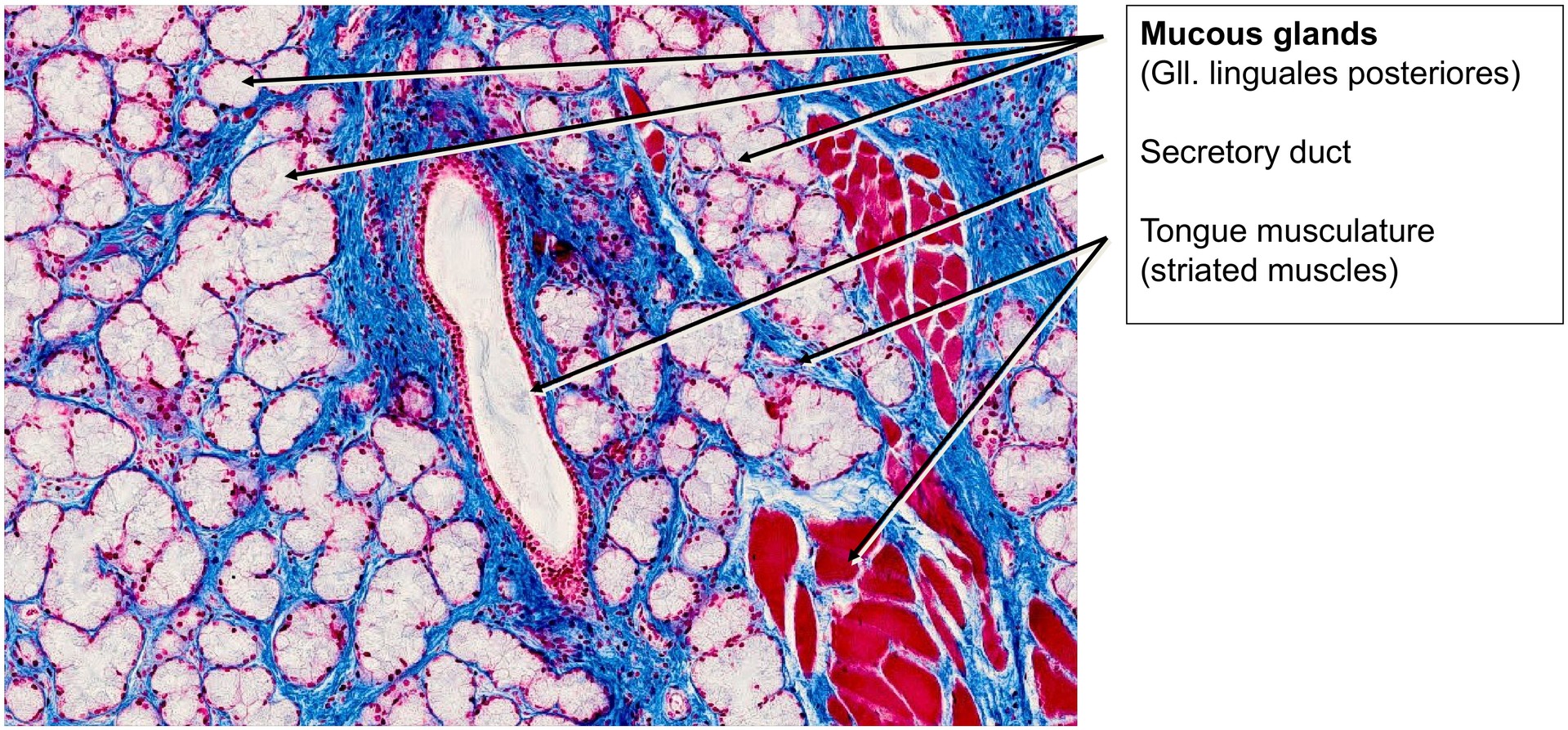 Lingual tonsil, base of tongue
