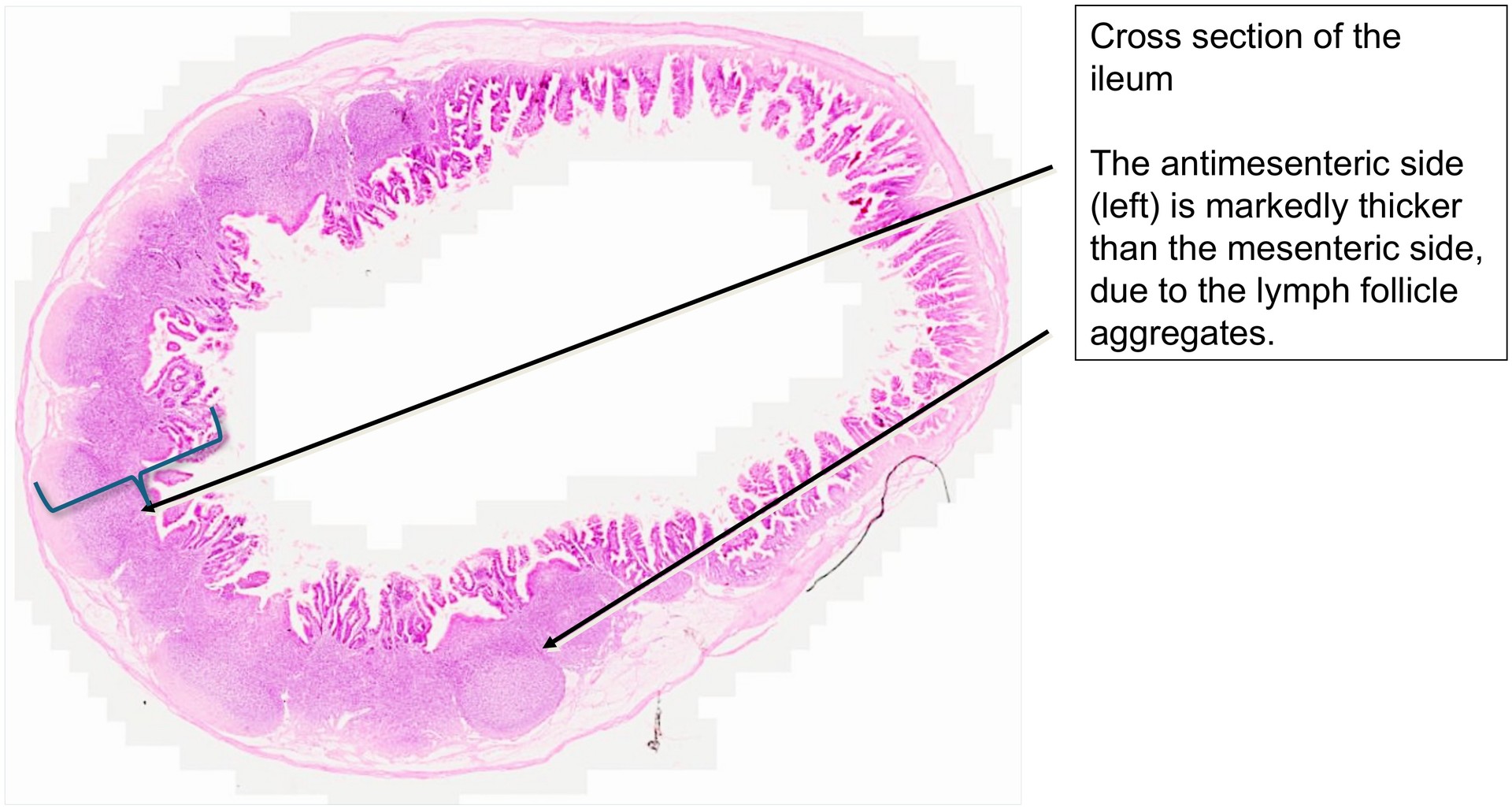 Ileum, Peyer’s patches