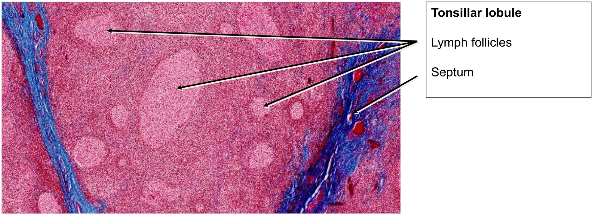Lingual tonsil, base of tongue