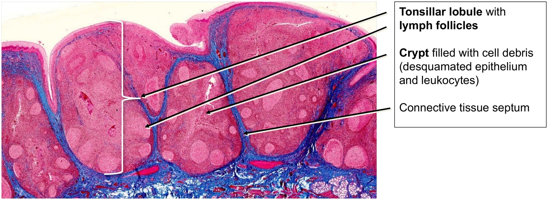 Lingual tonsil, base of tongue