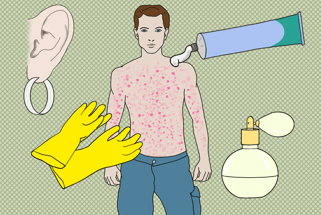 The illustration shows a human body covered with a skin rash as well as possible allergens that may have caused it; such as metals, fragrances, rubber chemicals, topical medication for example a cream.