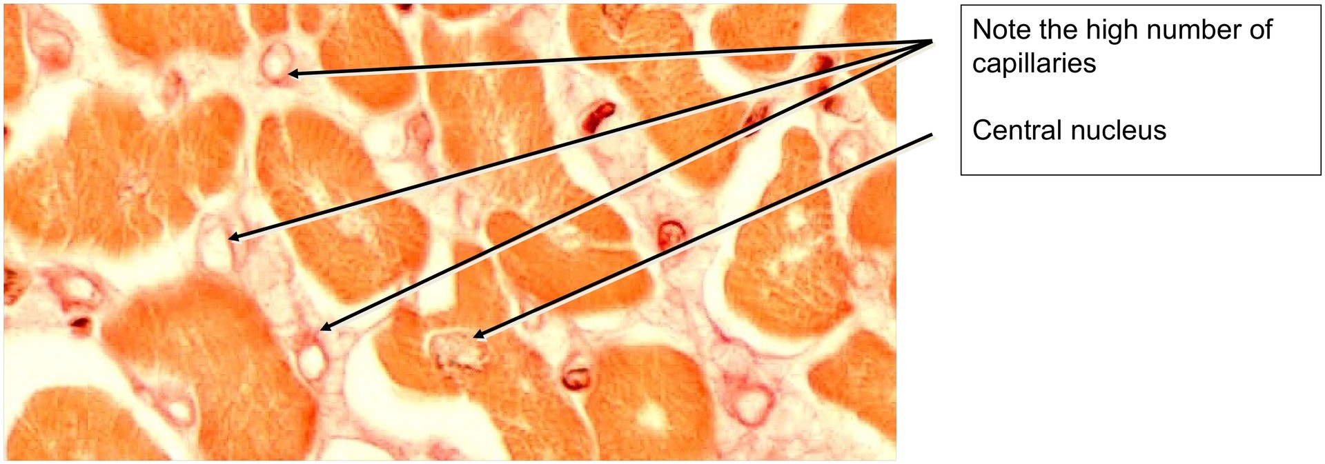Papillary muscle