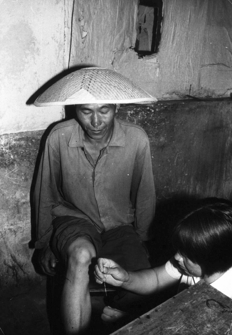 A Chinese barefoot doctor uses her needles to treat a production brigade worker